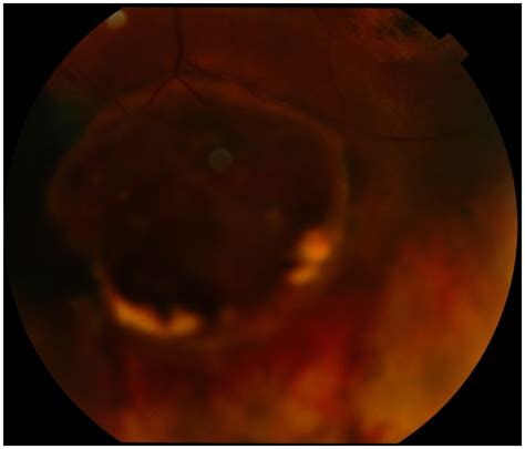 Fundus photograph of the left eye. Notes: Fundus photograph of the left... | Download Scientific ...