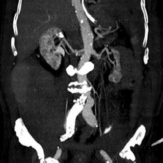 CT scan performed after endovascular aneurysm repair revealing a... | Download Scientific Diagram