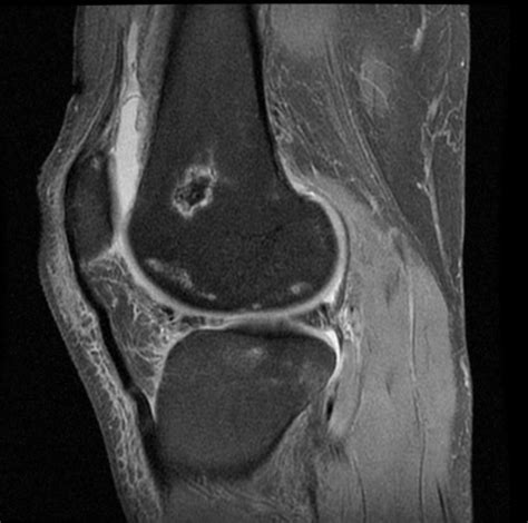 Bone Marrow Femur Mri