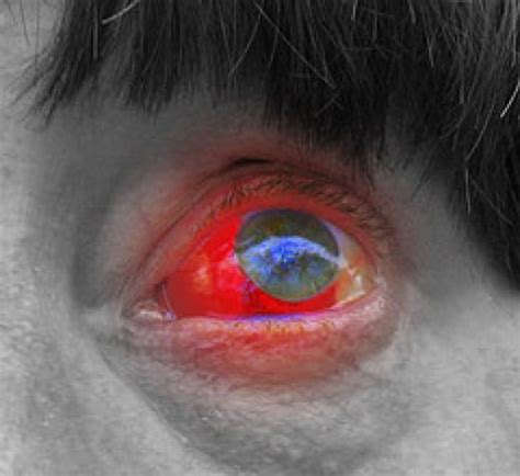 Blood in the eye. Causes, symptoms, treatment Blood in the eye