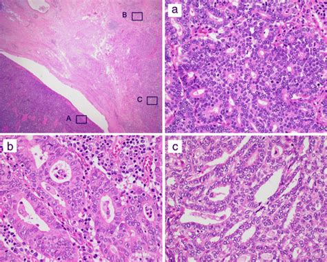 Histology of the pancreatic tumor. The tumor was composed mainly of ...