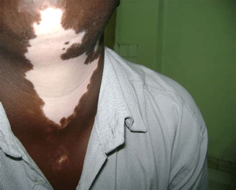 Focal vitiligo resistant to treatment with Oxabet. | Download ...