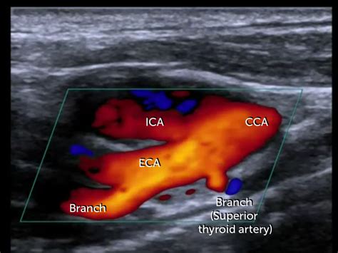 2. Carotid Ultrasound - Anatomy | 123 Sonography