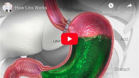 LINX® Reflux Management System | GERD Treatment in Birmingham, AL