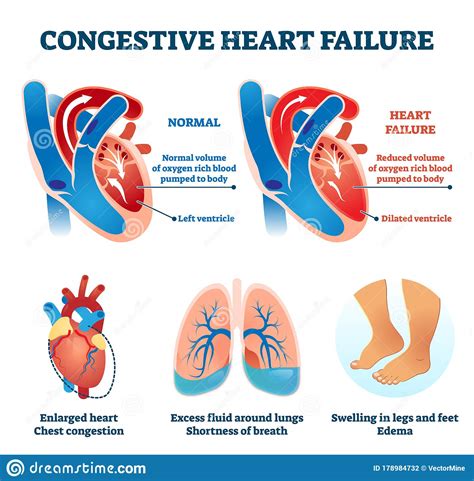 "Congestive Heart Failure" nghĩa là gì: Định Nghĩa, Ví Dụ trong Tiếng Anh