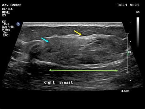 Atlas of breast cancer early detection