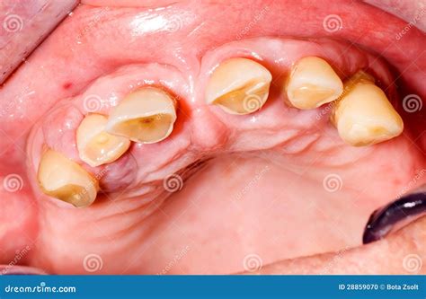 Teeth Abrasion Stock Photo - Image: 28859070