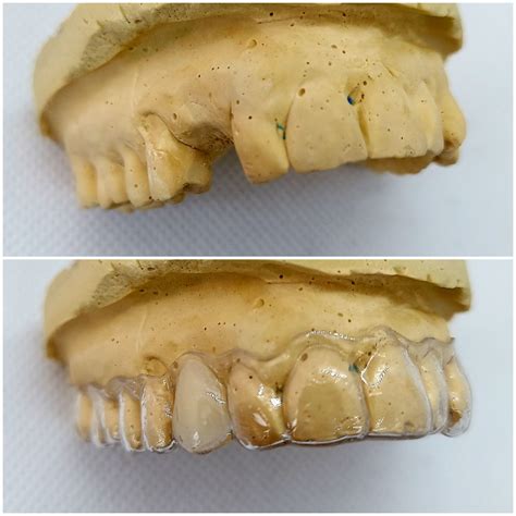 Essix Partial Denture Retainer - Dental Lab Direct