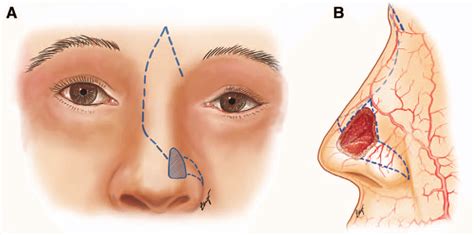 a, Frontal view of an additional myocutaneous rotation flap from the... | Download Scientific ...