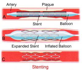 MIVIR Angioplasty and Stenting | MIVIR