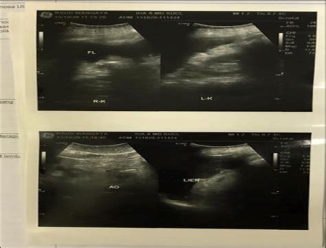 Patient's abdomen ultrasound result. | Download Scientific Diagram