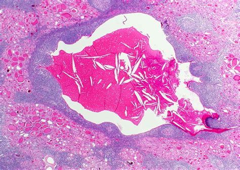 Branchial Cleft Cyst Histology