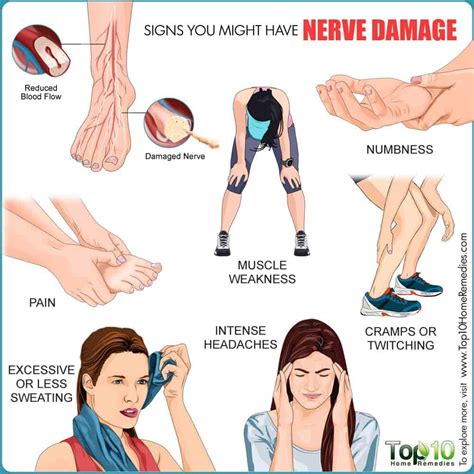 Nerve damage symptoms – Artofit