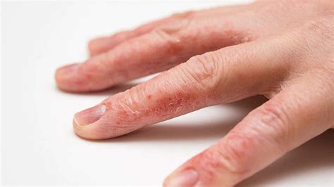 Delgocitinib Successful for Hand Eczema in Phase 2b Trial