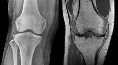 Segond Fracture | Radiology, Radiology student, Avulsion fracture