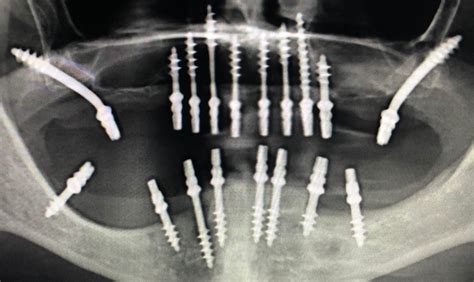 Basal implant vs. conventional dental implant: differences?