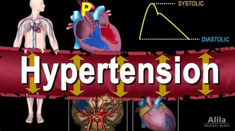 Hypertension - High Blood Pressure, Animation - How Does It Work