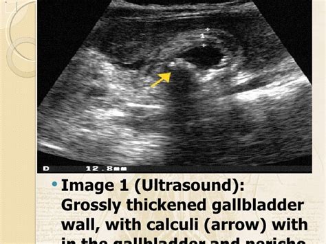 Acute Cholecystitis