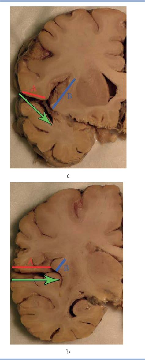 Figure 1 from [Surgical anatomy of the insular cortex]. | Semantic Scholar