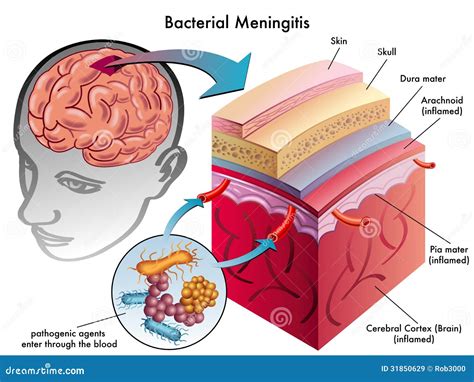 Bacterial Meningitis Royalty Free Stock Images - Image: 31850629