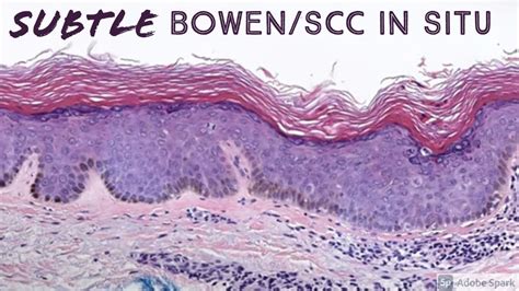 Subtle squamous cell carcinoma in situ (Bowen disease) +/- Large cell ...