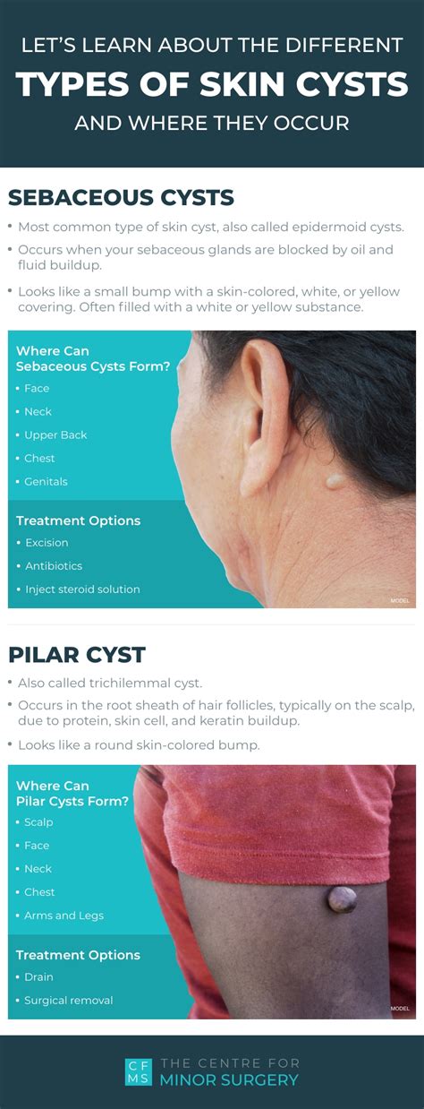 What Are the Different Types of Skin Cysts & Where Do They Occur ...