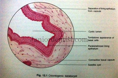 Histologic or Microscopic Features of Odontogenic Keratocyst