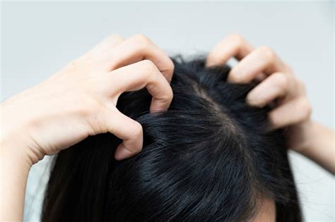 5 Obat Kutu Rambut yang Paling Manjur untuk Membasmi Kutu - Alodokter