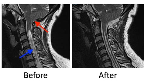 Chiari Malformation — Matthew Mian, MD