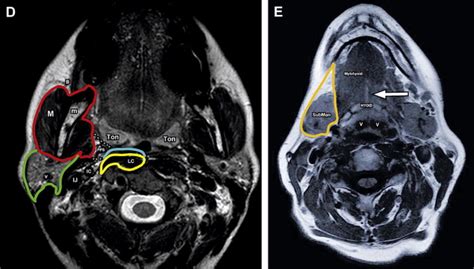 Cálculo Increíble Línea de visión mri neck anatomy Para aumentar ...