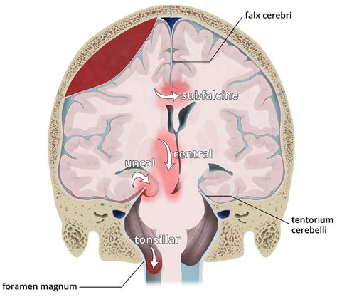 Brain herniation causes, types, signs, symptoms, prognosis and treatment