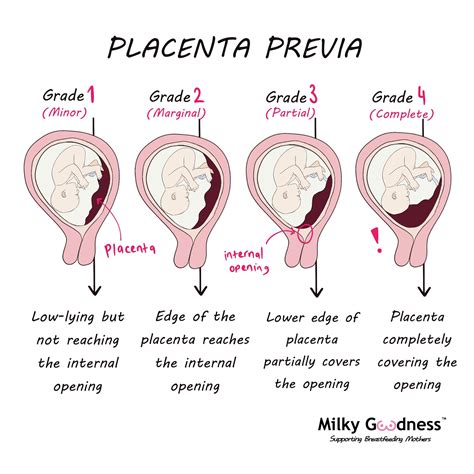 When Is Placenta Removed After Delivery