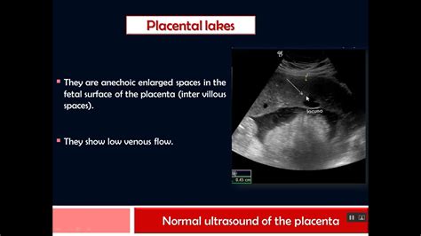 Placenta Lesions Imaging Sonography Placenta X Ray Ultrasound | The Best Porn Website