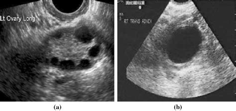 What Does An Ovary Look Like On Ultrasound