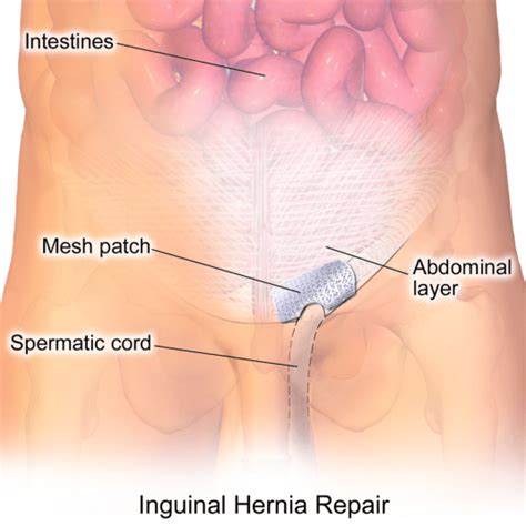 What is the Difference Between Seroma and Hernia | Compare the Difference Between Similar Terms