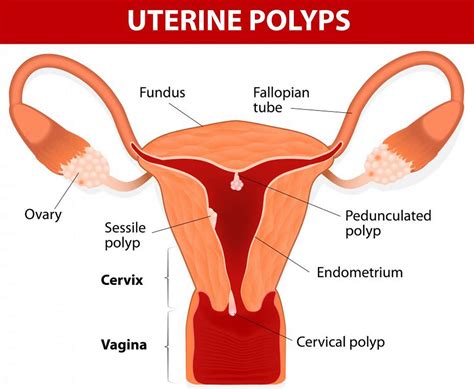 Uterine Polyps - Endometrial Polyp - Causes, Symptoms, Treatment