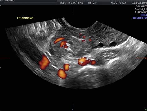 Diagnosing Ovarian Torsion With Ultrasound | Empowered Women's Health