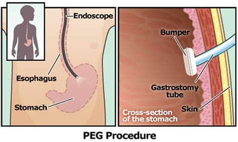 PEG Tube - Placement, Removal, Replacement, Complications