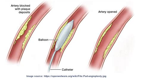 BALLOON ANGIOPLASTY