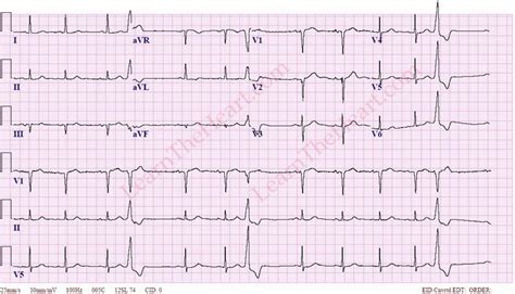 いろいろ sinus tachycardia with pvc 113144-Sinus tachycardia with pvc and pac