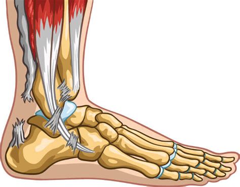 Achilles Tendon Rupture Treatment | Johns Hopkins Department of ...