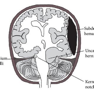 CT of the head after craniotomy and evacuation of subdural hematoma... | Download Scientific Diagram