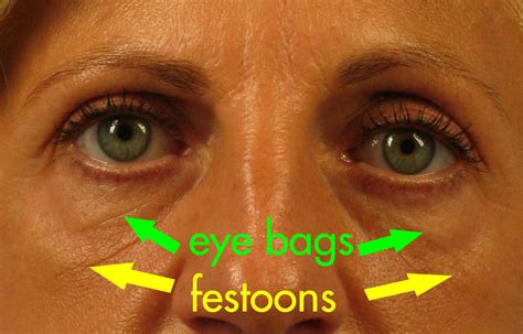 What Are Festoons? | Dr. Brett Kotlus, Cosmetic Oculoplastic Surgeon, NYC