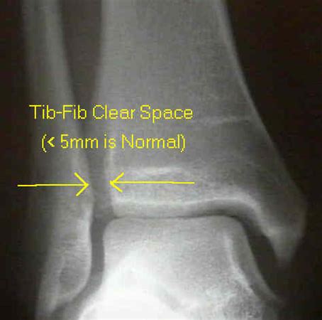 Ankle Fractures - Trauma - Orthobullets