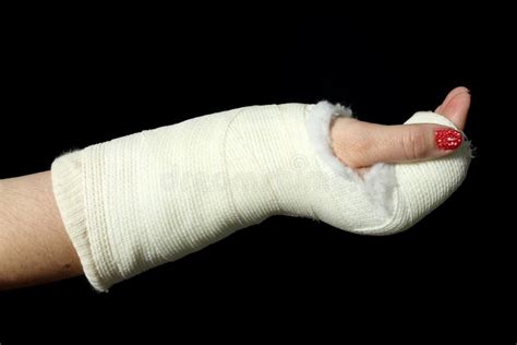 Orthopedic cast stock photo. Image of fracture, black - 49499602