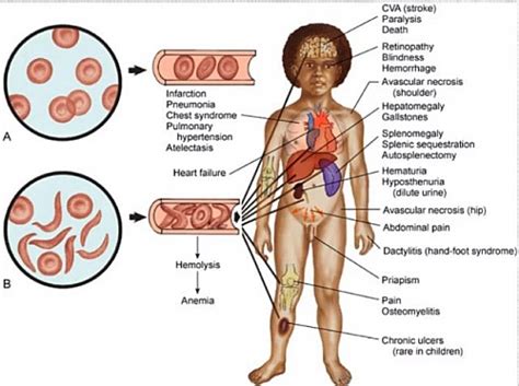 Sickle Cell Disease – Little Cell of Mine Foundation