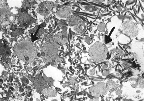 Mechanism of Thrombus Formation in Regard to Diet | IntechOpen