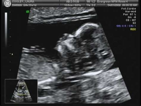 4D, 3D at the end. Baby boy 13 weeks - YouTube