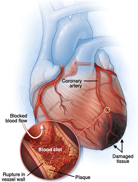 Myocardial Ischemia - Causes, Diagnosis, Symptoms, Treatment