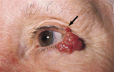 Mucinous Eccrine Carcinoma of the Eyelid | JAMA Ophthalmology | The JAMA Network